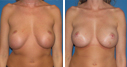 Before & After Photos